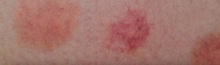 Grasmijten: Info en bestrijding van de herfstmijt